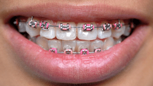 Braces