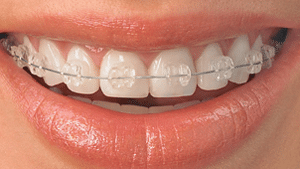 Ceramic-Braces